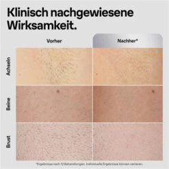 Braun IPL-Haarentfernung Silk-expert Pro 5 PL5145, Mit 2 Aufsätzen, Gillette Rasierer Und Tasche -Körperpflege Store 9f171d34097937ffac5f407f08f197eb20bc35ae ipl haarentfernung braun silk expert pro 5 pl5145